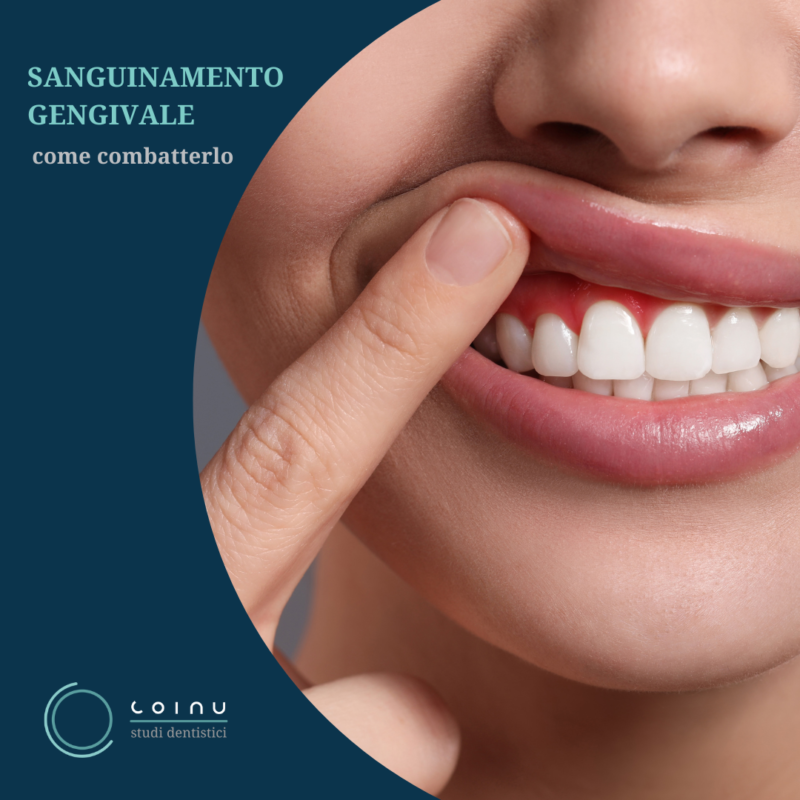 Sanguinamento gengivale